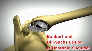 How To Tell If You Have A Shoulder Dislocation Or A Hillsachs Bankart Lesion [upl. by Yornek]