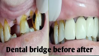 Fix dental bridge before and after [upl. by Sualkcin]