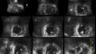 ACUTE MYOCARDIAL INFARCTION ANTEROSEPTAL 3D ECHOCARDIOGRAPHY cardiac ultrasound [upl. by Cirded]