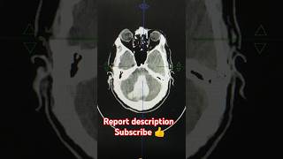 ncct head pathology detail report description radiology anatomy pathology hemantkushwah3453 [upl. by Dodwell]