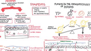 Asthma  signs and symptoms pathophysiology [upl. by Eelrahc]