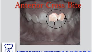 CrossBite Correction [upl. by Chandos790]