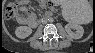 Malpositioned IVC filter penetrating vertebral body and aorta [upl. by Hutchinson241]