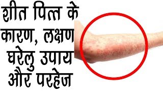 शीत पित्त UrticariaयाHives के कारण लक्षण घरेलु उपाय Effective Home Remedies For Hives [upl. by Uhp323]