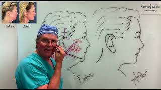 SMAS vs Deep Plane Facelift What You Need to Know  Philadelphia Facelift Surgeon Dr Claytor [upl. by Etiragram827]