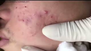 Acne treatment at home  squeeze pimple horror003 [upl. by Elder]