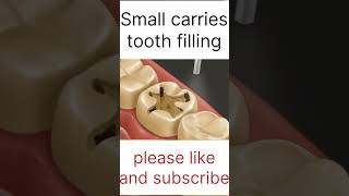 Small carries tooth filling asmr 3d localdentistry cavityfilling youtubeshorts ytshortsindia [upl. by Ecyak]