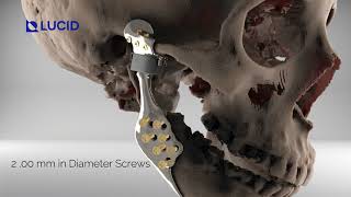 Total Joint Replacement TJR Animated Video  Custom TMJ Prosthesis [upl. by Ellebasi]