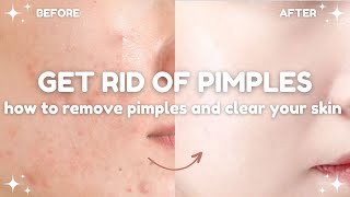 how to get rid of pimples and clear your skin 🧴🫧 acne treatments and dos and donts [upl. by Ydnolem]