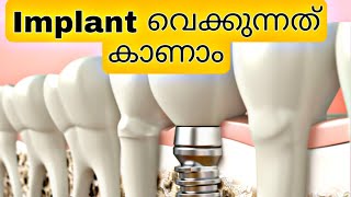 Implant വെക്കുന്നത് കാണാം  dental implant malayalam  dental implant  implant veppu pallu [upl. by Aileek195]