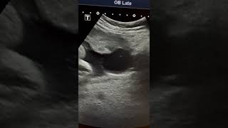 Placental cyst Ultrasound in 3rd trimester pregnancy ARDMD sonography [upl. by Aleedis]