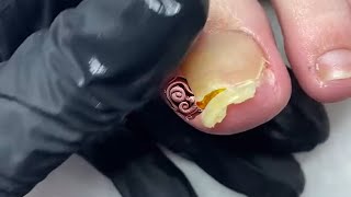 TRIMMING fungal Toenail with onycholysis [upl. by Loredo371]