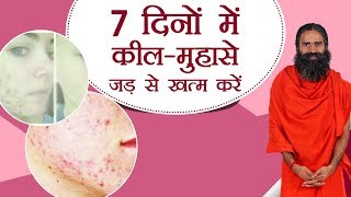 7 दिनों में कील मुँहासे Pimples Acne जड़ से खत्म करें  Swami Ramdev [upl. by Tsirhc]