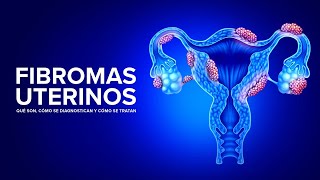 Fibromas Uterinos  Qué son cómo se diagnostican y cómo se tratan [upl. by Yrellav242]