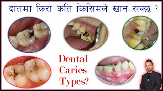 Dental Caries Classification Doc Taj दाँतको कस्तोकस्तो भागमा किराले खान्छ Dentist in Kathmandu [upl. by Grania]