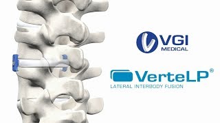 VGI Medical presents VerteLP® Lateral Interbody System [upl. by Atneuqal130]