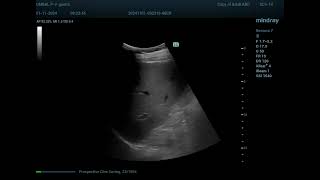 Adrenal adenoma [upl. by Dyal]