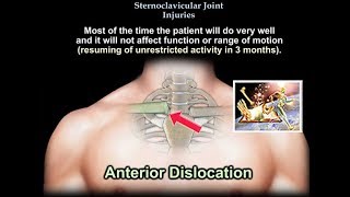 Sternoclavicular Joint Injuries  Everything You Need To Know  Dr Nabil Ebraheim [upl. by Gainor]