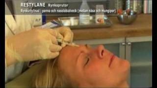 Restylane och Botox behandling [upl. by Leonidas]