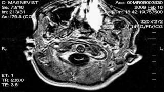 Stevens Brain MRI 21609 [upl. by Eityak819]