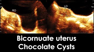 Practical ultrasound case of Bicornuate uterus  Endometriosis  Chocolate Cysts  Nabothian cyst [upl. by Maynord]