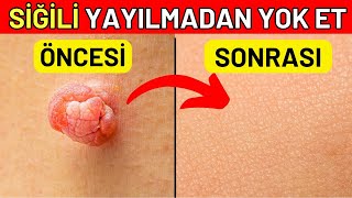 Siğilleri BİR GECEDE Yok Eden Doğal İlaç Siğiller Sağlığınız Hakkında Sizi Uyarıyor [upl. by Lallage]