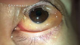 Chemosis of Conjunctiva [upl. by Aidahs]