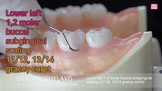 Lower left 12 molar buccalsubgingival scaling 1112 1314 gracey curet [upl. by Koblas]