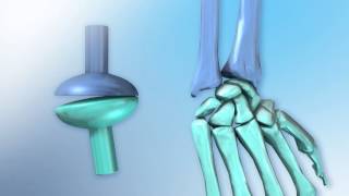 Condyloid Joint [upl. by Nessy]