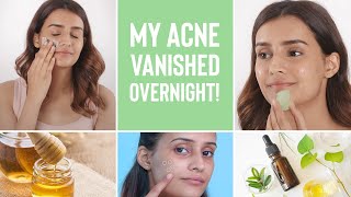 How To Make Your Acne Disappear Overnight  4 Home Remedies For Pimples [upl. by Akcirderf219]