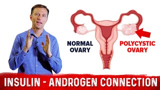 Why Does Insulin Cause PCOS Polycystic Ovary Syndrome – DrBerg [upl. by Ayom221]