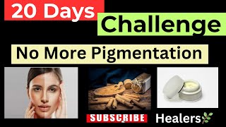 20 Days Challenge to remove Pigmentation  आसान तरीक़ा झाईयाँ मिटाने का [upl. by Aihsile]