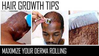 Microneedling for Hair Regrowth  Genuine Tips [upl. by Ellekim]