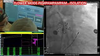 PAROXYSMAL ATRIAL FIBRILLATION FARAPULSE CASE SKIN TO SKIN 30 MIN [upl. by Annaet]