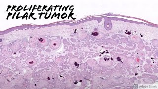 Proliferating Pilar TumorProliferating Trichilemmal Tumor 5Minute Pathology Pearls [upl. by Parsons838]