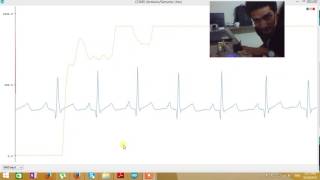 ECG and PPG to extract PTT for Cuffless blood pressure [upl. by Nerraf97]