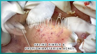 Big Cystic Acne Blackheads Extraction Blackheads amp Milia Whiteheads Removal Pimple Popping [upl. by Seften]