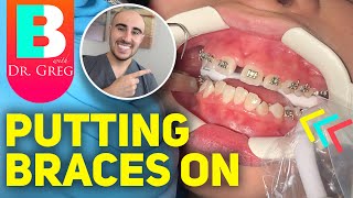 Getting Braces Put On and COLORS Vlog of Time Lapse [upl. by Carlynne]