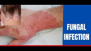 Fungal infectionskin Dr how to treat fungal infection [upl. by Freeman]