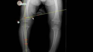 TraumaCad  MetaphysealDiaphyseal Angle [upl. by Tracy995]