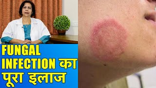 फंगल इन्फेक्शन का पूरा इलाज  Complete Treatment of Fungal Infections [upl. by Pollerd]