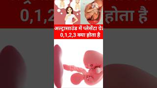 Pregnancy Ultrasound me Placenta Grade 0123 kya hota hai shorts pregnancy placenta pregnant [upl. by Aicelf]