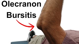 Olecranon Bursitis [upl. by Htezil577]