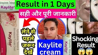 kaylite cream  kaylite cream ke fayde  kaylite cream lagane se kya hota hai  kaylite cream review [upl. by Brendin3]