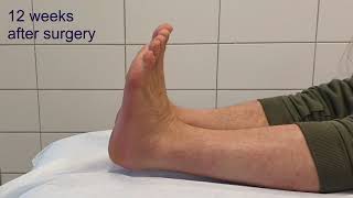 calcaneus fracture comminuted Sanders 4  minimal invasive surgery  clinical course [upl. by Airet734]