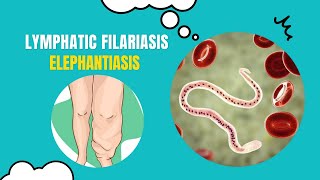 Unlocking the Secrets of Elephantiasis What You Need to Know [upl. by Schaffel]