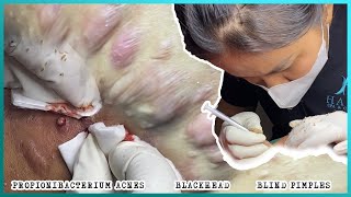 Big Cystic Acne Blackheads Extraction Blackheads amp Milia Whiteheads Removal Pimple Popping [upl. by Mozelle]