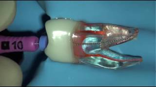 Cleaning and shaping root canals using the iRace sequence [upl. by Dailey]