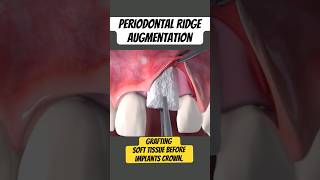 Ridge Augmentation Soft tissue Grafting Dental Implants [upl. by Rankin]