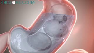 Obalon Gastric Balloon Los Angeles 2020Dr David DavtyanBeverly Hills GlendaleRancho Cucamonga [upl. by Lothair]